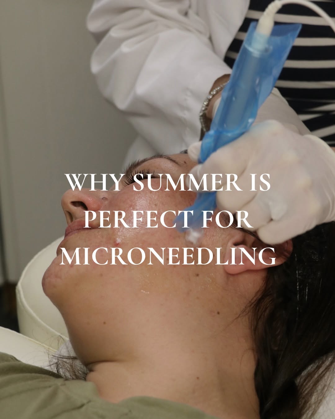 Instagram post by Dr. Susan Stevens Tanne: Think microneedling is only for the cooler months? Think again… With the right aftercare and daily sun protection, summer can be a great tim…
