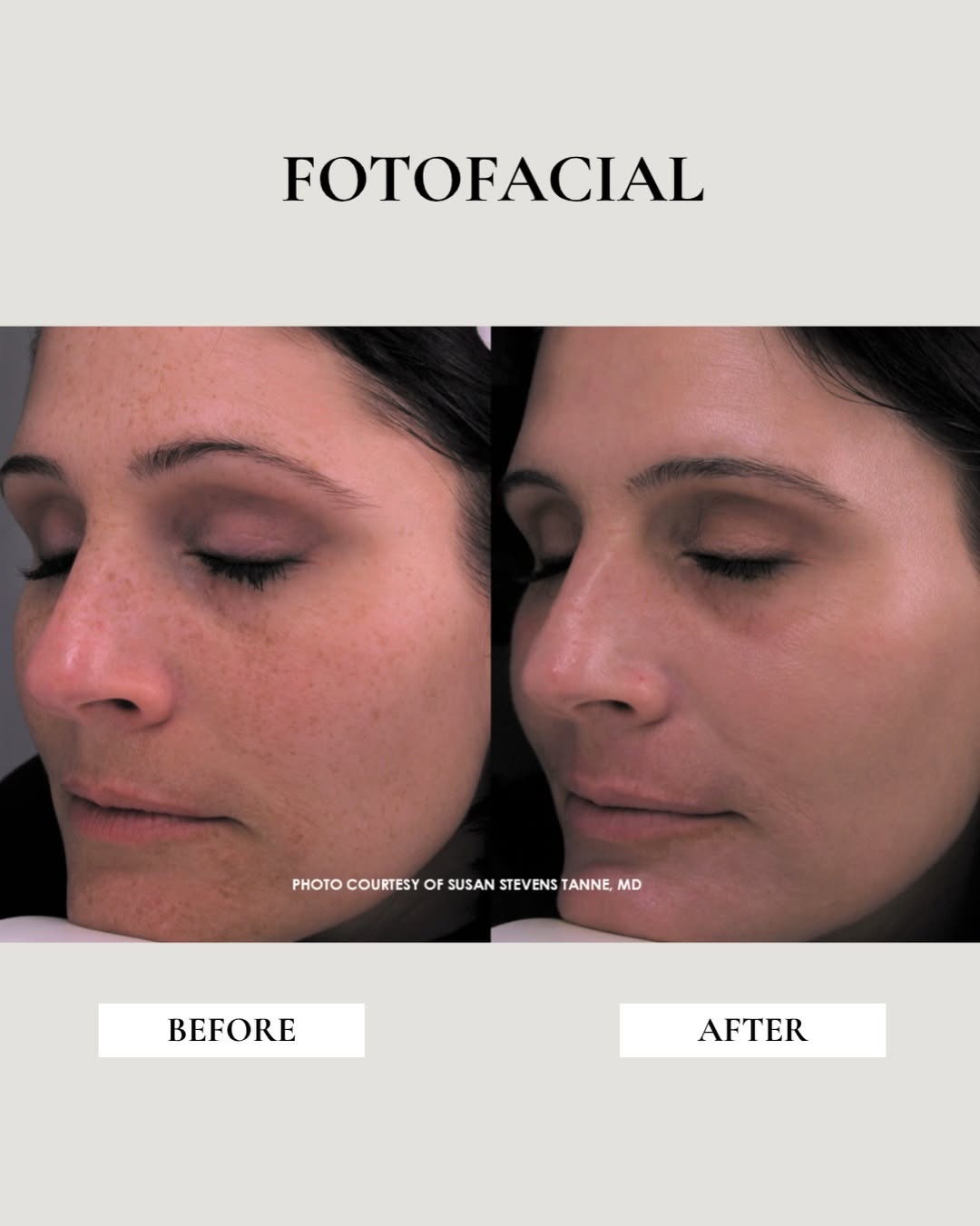Instagram post by Dr. Susan Stevens Tanne: The before + after speaks for itself🤍 If sun damage, brown spots, or uneven pigmentation are keeping your skin from looking as clear and ev…
