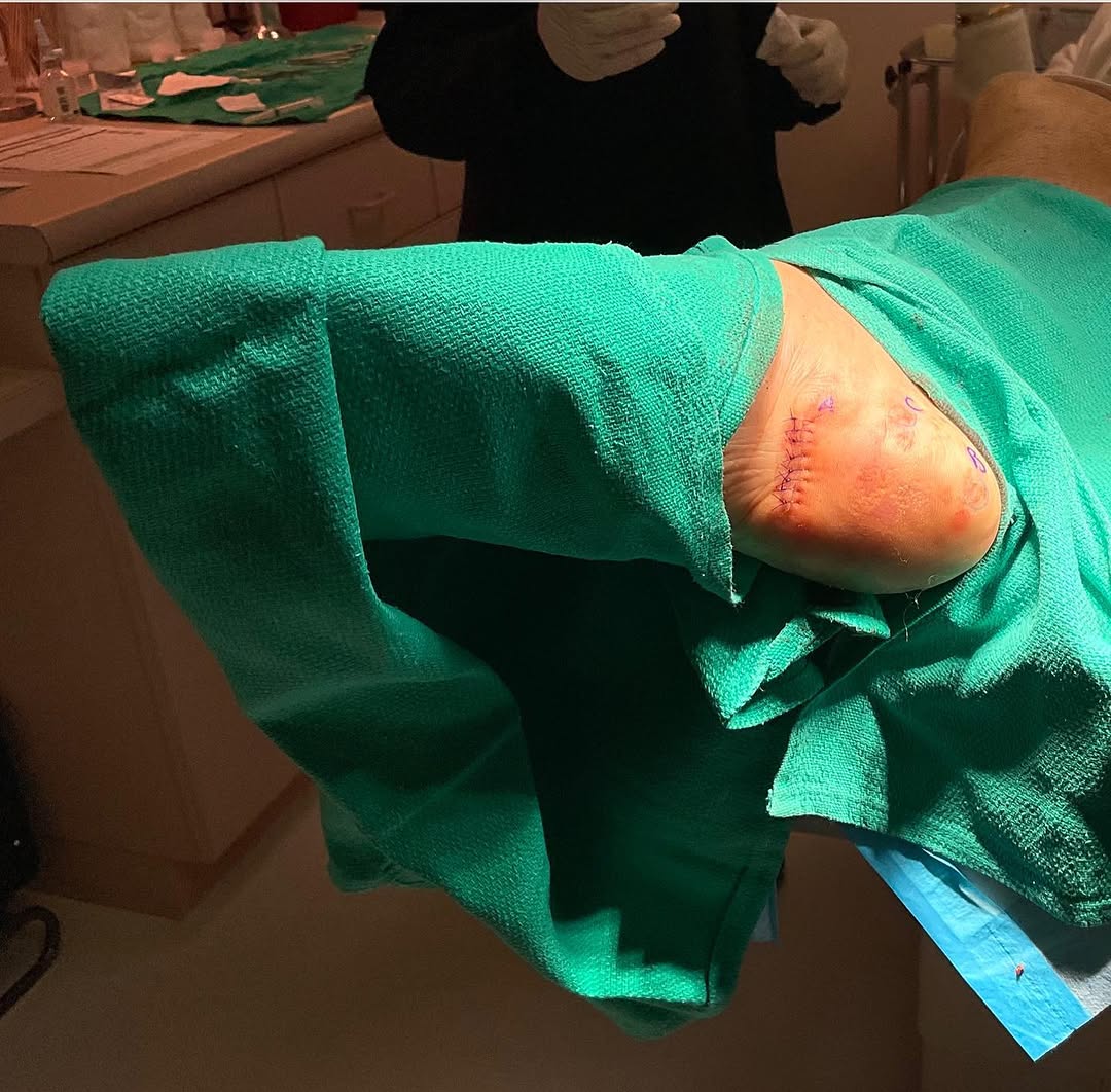 Instagram post by Dr. Susan Weinkle: This is a surgery I did on a patient that flew 36 hours from Mauritius because she only wanted me to perform her surgery😃✈️. I feel honored…