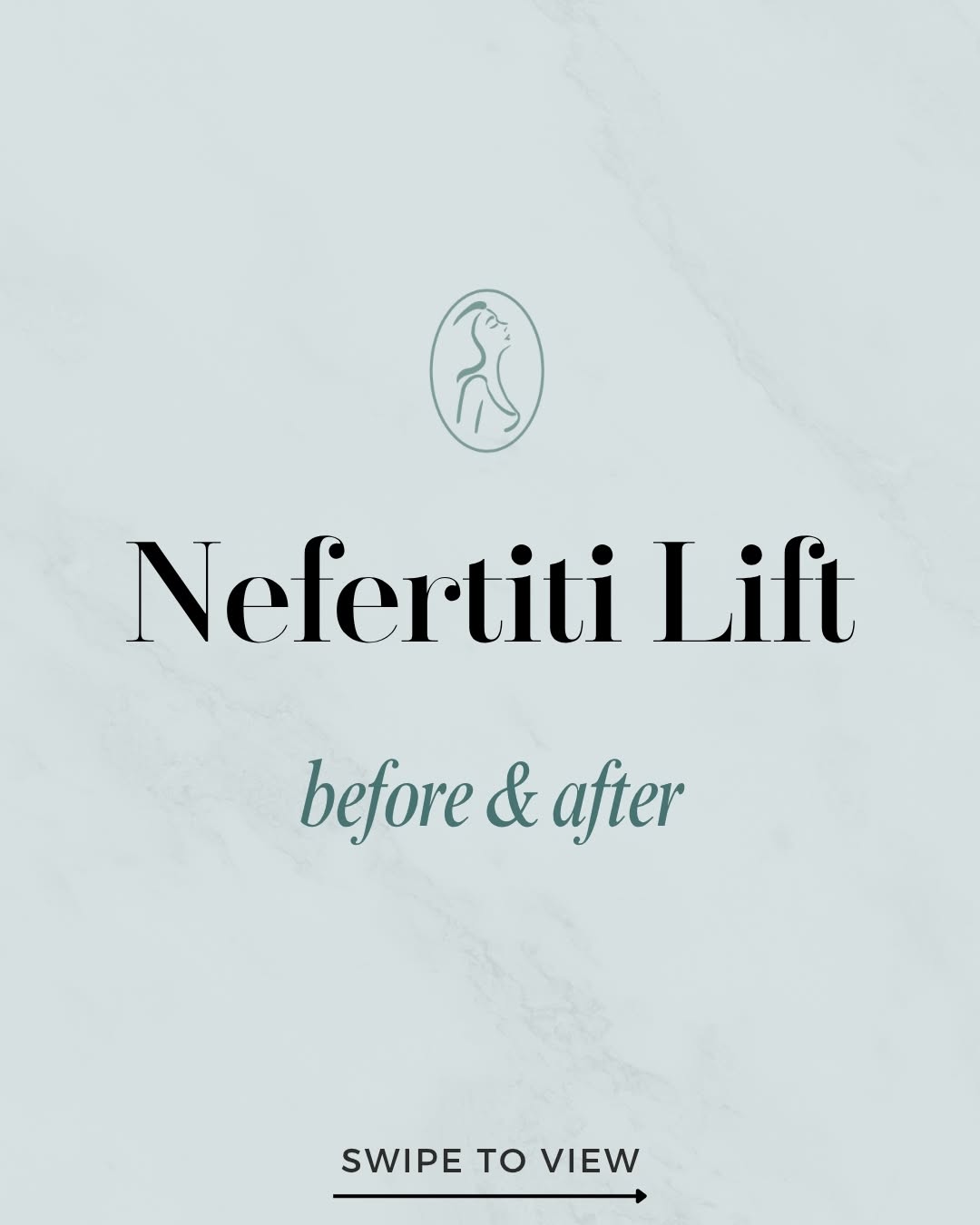 Instagram post by Dr. Sutton Graham II: The Nefertiti Lift, defined. 🙌 At 30, this client had platysmal bands showing at rest and lower face asymmetry. Ashley Savard, RN, CANS pla…