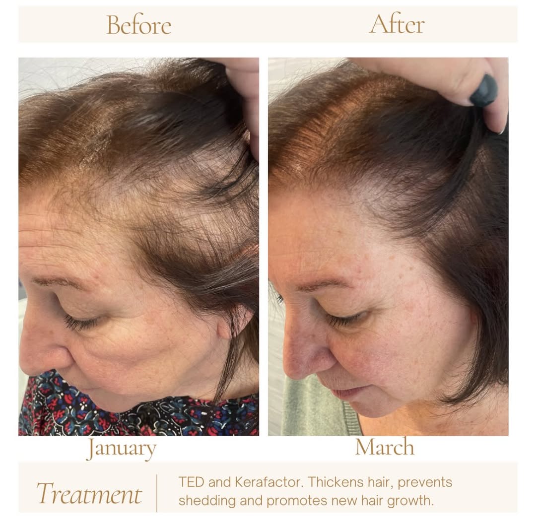Instagram post by Dr. Suzanne Sirota Rozenberg, DO, FAOCD, FAAD: This is the magic of TED & Kerafactor & @srsdermatology 🤯🤯🤯 #hairloss #almaTED #kerafactor #boardcertifieddermatologist