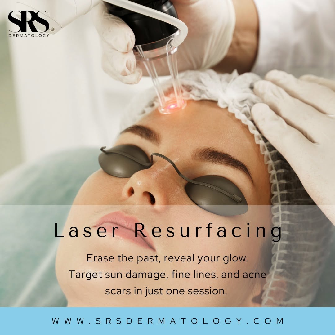 Instagram post by Dr. Suzanne Sirota Rozenberg, DO, FAOCD, FAAD: Sun damage, stubborn acne scars, and fine lines don't have to be permanent parts of your story. Laser Resurfacing works like a reset button …