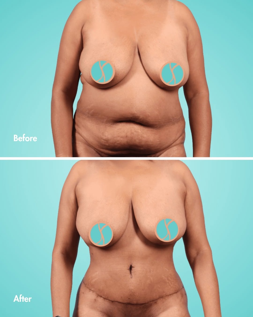 Instagram post by Dr. Suzanne Yee: Before and after tummy tuck with liposuction by Dr. Yee ✨ This 53-year-old patient came in wanting to address excess fat in her abdomen and …