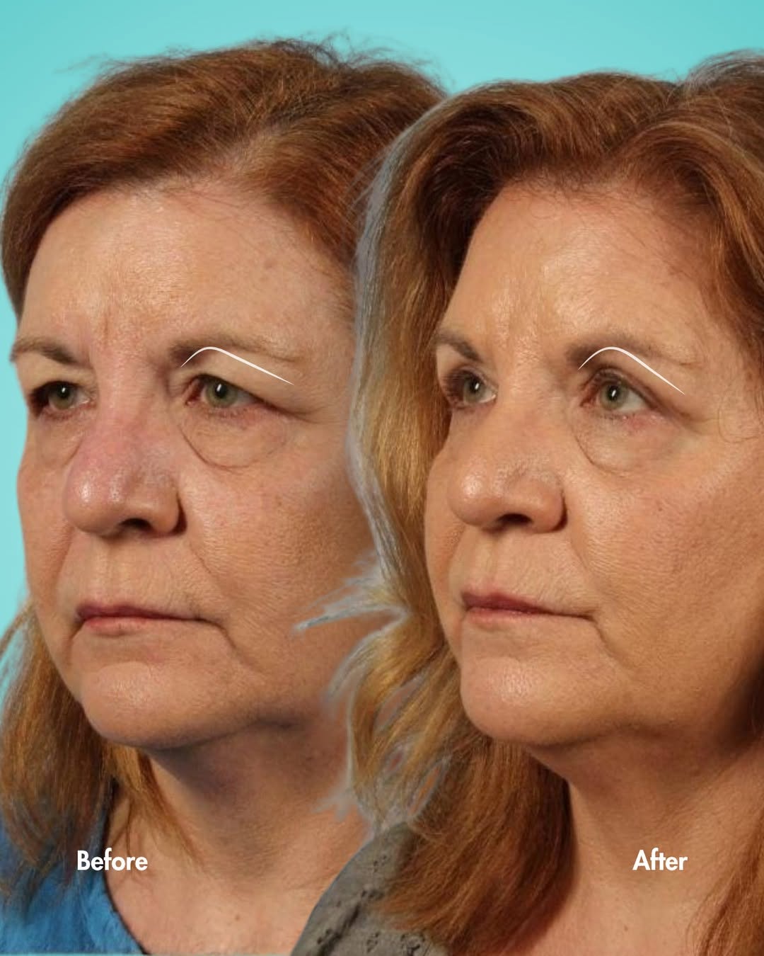 Instagram post by Dr. Suzanne Yee: Upper bleph before and after by Dr. Yee 👀 This patient came in with heavy, drooping upper eyelids that were affecting both her appearance a…