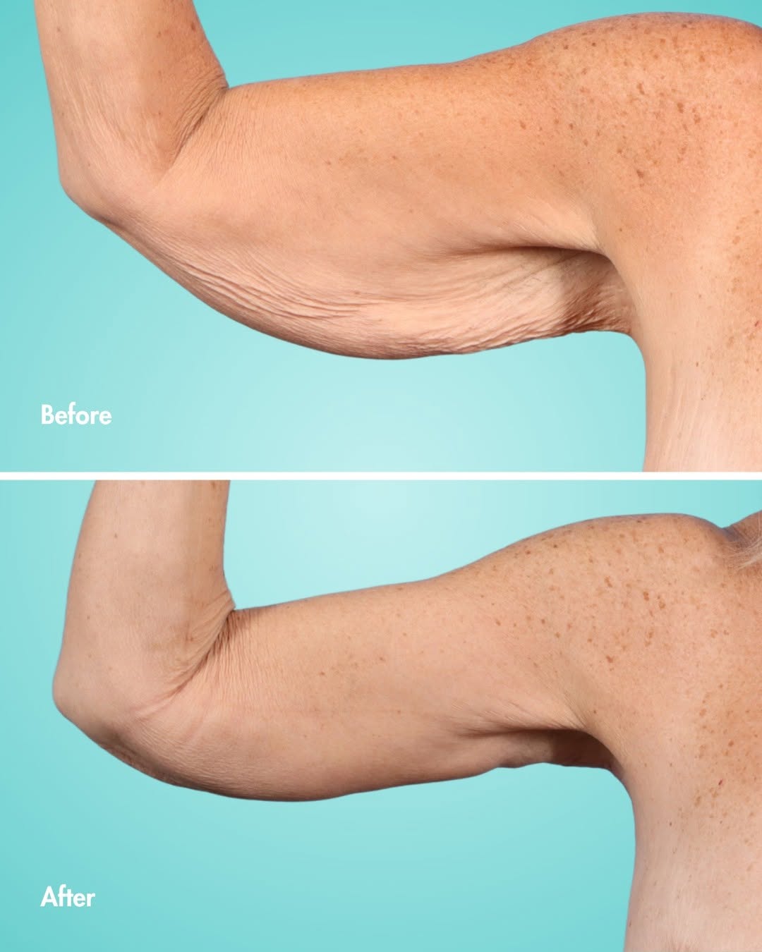 Instagram post by Dr. Suzanne Yee: Before & after by Dr. Pournik ✨ This patient came in wanting to address excess skin and fat in her upper arms and sides of the chest. Dr. Po…