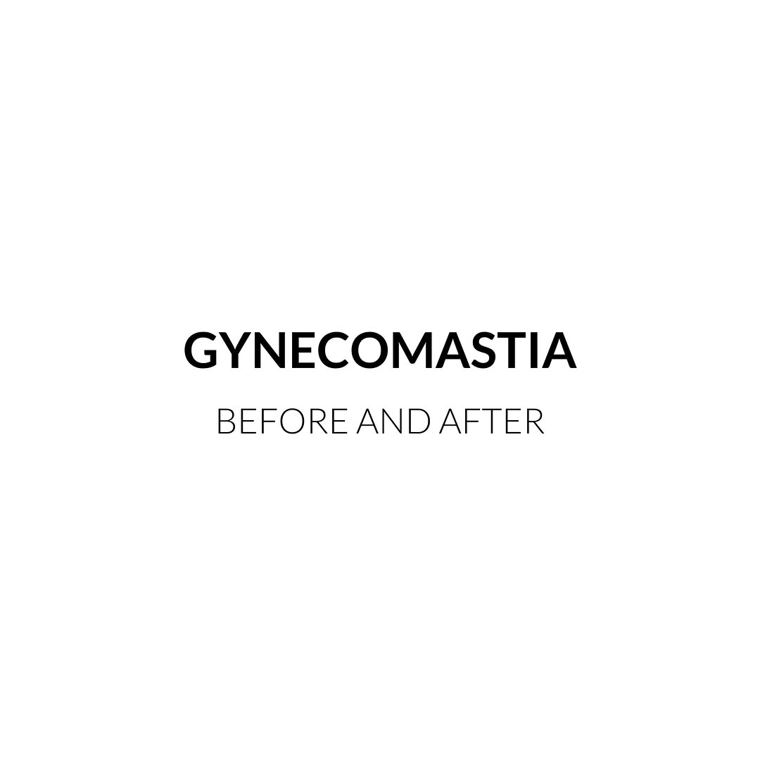 Instagram post by Dr. Svetlana M. Danovich: Before and After: Gynecomastia Surgery | 3 Months After Breast Tissue Excision These before-and-after photos show the results 3 months after…