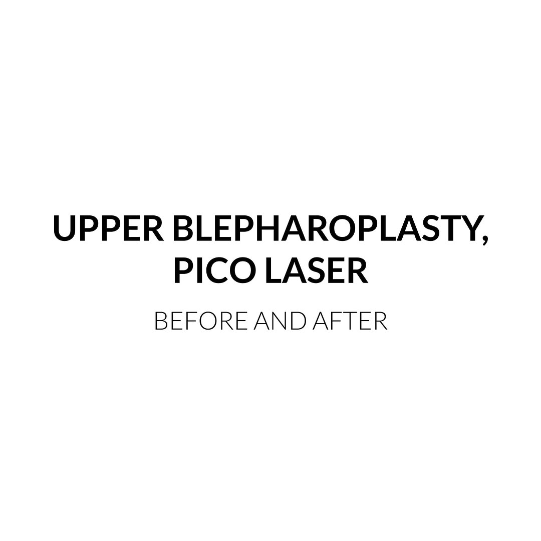 Instagram post by Dr. Svetlana M. Danovich: Before and After: Upper Blepharoplasty, PICO laser session This lovely patient underwent upper blepharoplasty to remove excess eyelid skin a…
