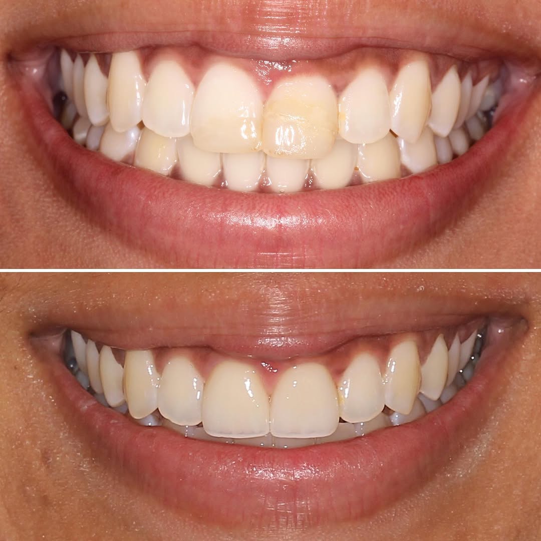 Instagram post by Dr. Sylvan Fain: Porcelain veneers to replace old failing composite bonding. #porcelainveneers #smilemakeover #veneers