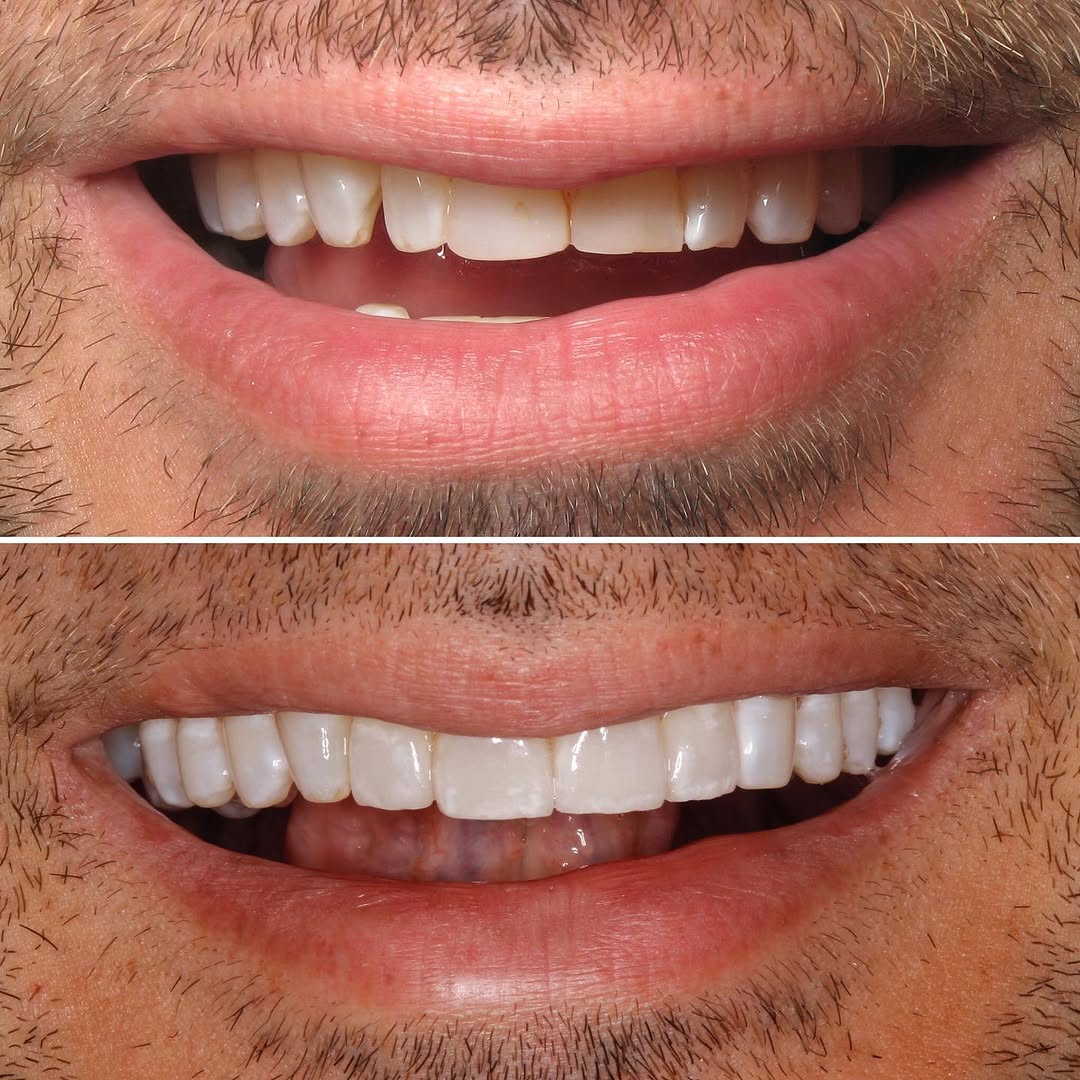 Instagram post by Dr. Sylvan Fain: Smile makeover with whitening and four porcelain veneers to improve symmetry. #veneers #porcelainveneers #dentist #miami #miamidentist #miam…