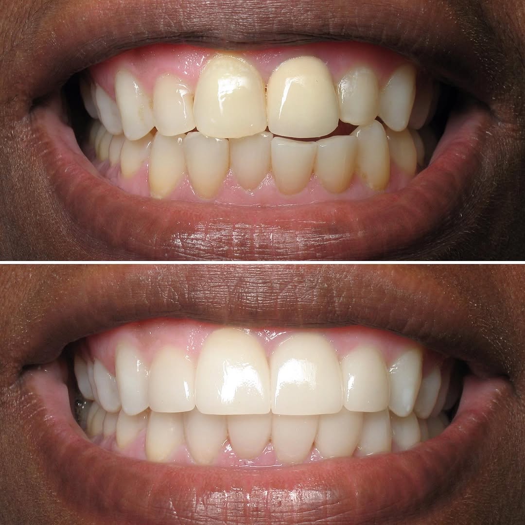 Instagram post by Dr. Sylvan Fain: Smile makeover with combination of porcelain veneers, porcelain crown and whitening. #veneers #porcelainveneers #dentist #miami #miamidentis…
