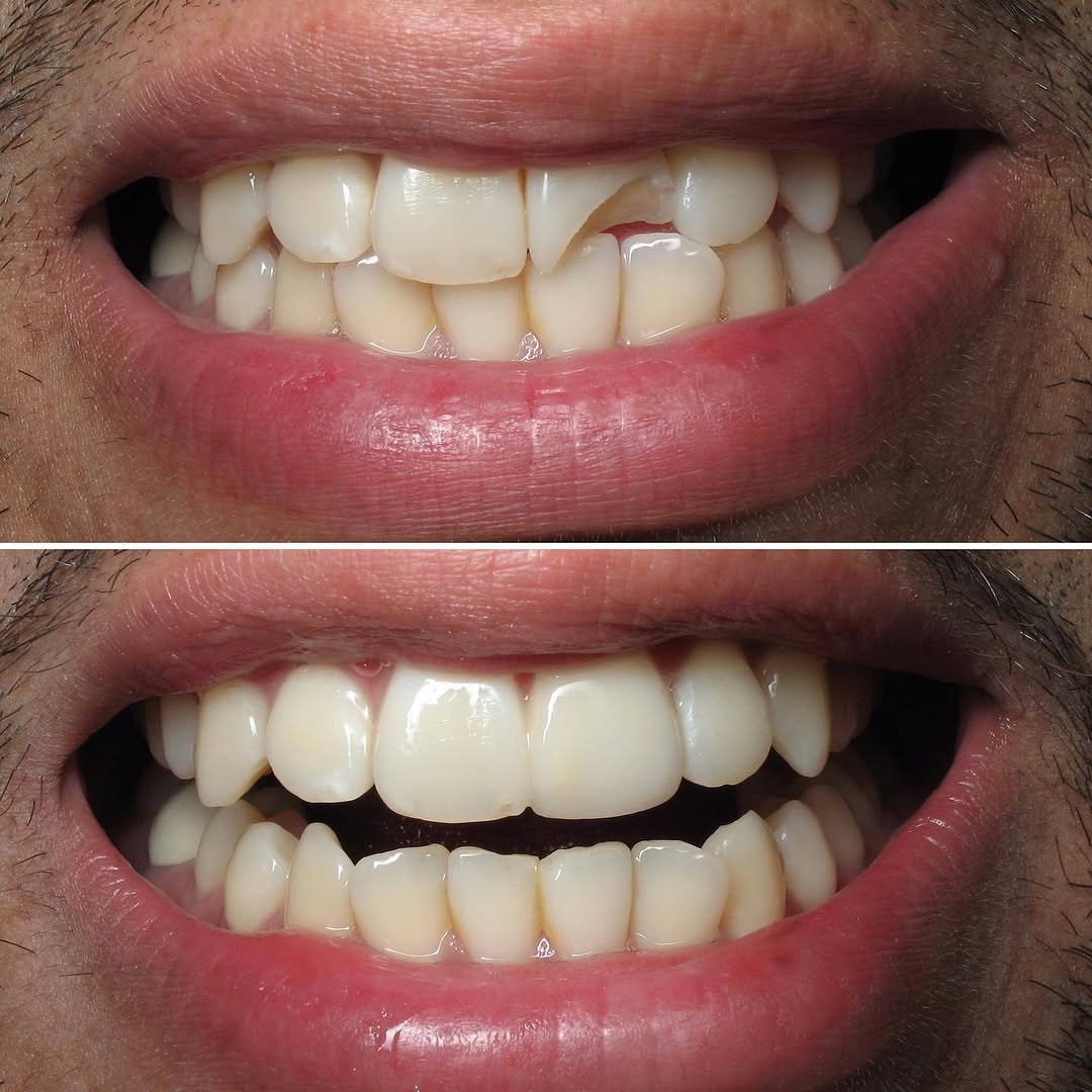 Instagram post by Dr. Sylvan Fain: The most difficult procedure in cosmetic dentistry is matching a single porcelain crown or veneer to a natural tooth. #veneers #porcelainven…