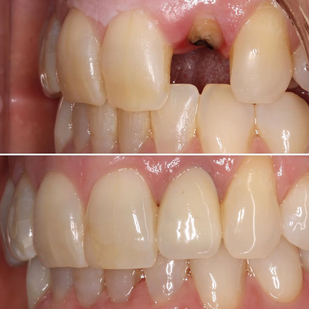 Instagram post by Dr. Sylvan Fain: Losing a front tooth can be a traumatic experience. This patient fell and fractured her tooth. Replacing a single front tooth with a dental …