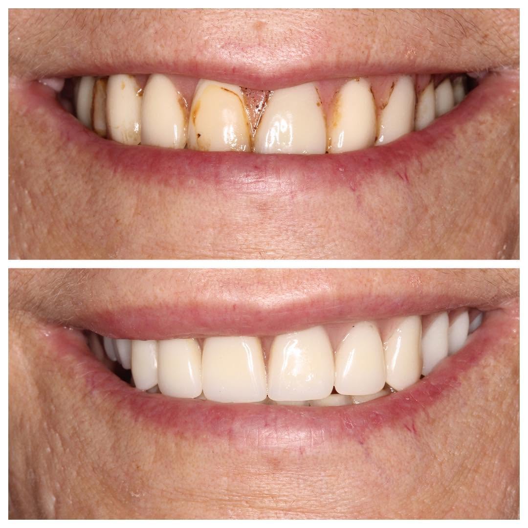 Instagram post by Dr. Sylvan Fain: The before picture shows an old implant retained denture (acrylic hybrid) that was made over 10 years ago. The prosthesis had many chips and…