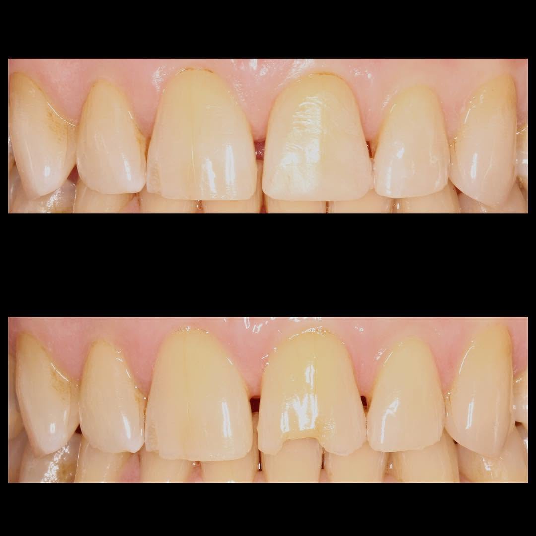 Instagram post by Dr. Sylvan Fain: Cosmetic bonding and cosmetic recontouring. #cosmeticdentist #cosmeticdentistry #northmiamidentist #dentalbonding #miamidentist #faindentala…