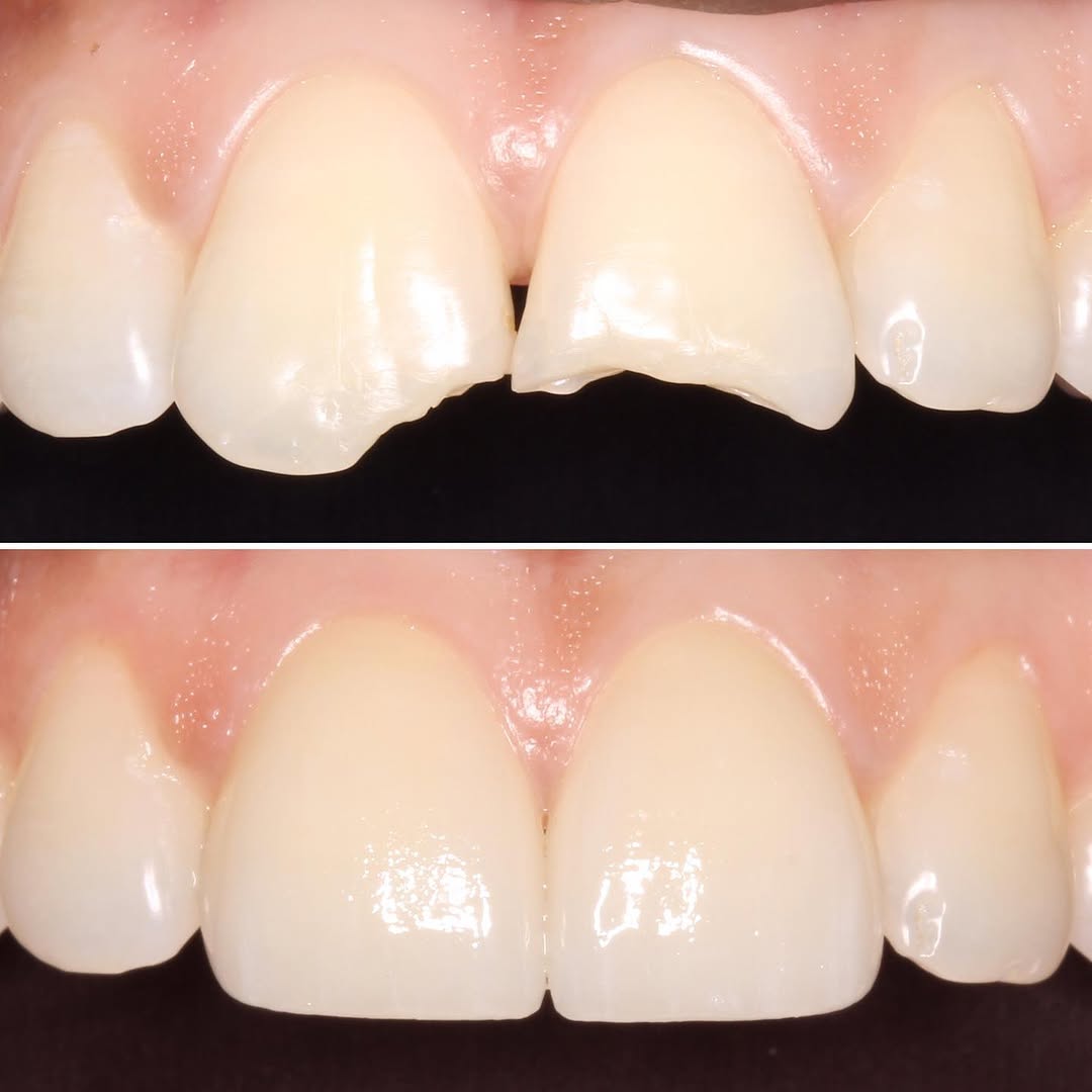 Instagram post by Dr. Sylvan Fain: Patients often ask: “Will my #veneers look fake?” Well placed #porcelainveneers should blend in seamlessly with the neighboring teeth. #dent…