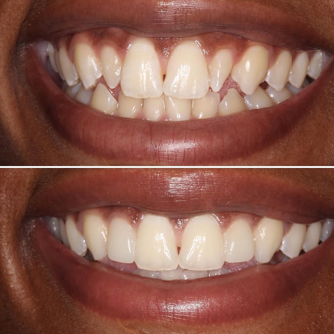 Instagram post by Dr. Sylvan Fain: This patient was unhappy with her peg shaped teeth and her “vampire” canines. Direct #compositeveneers were placed on the lateral incisors a…