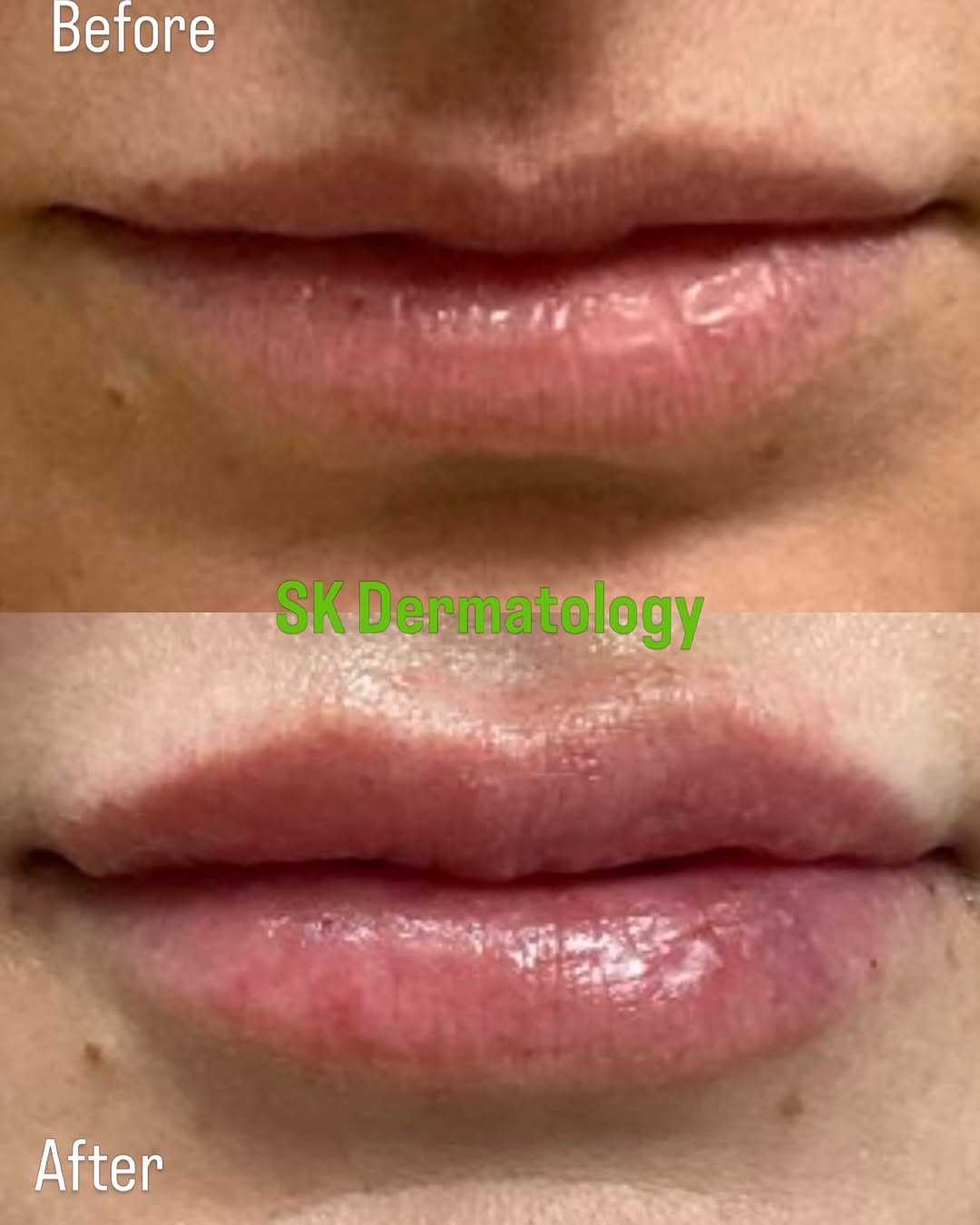 Instagram post by Dr. Sylvie Khorenian: Upper and lower correction of slight lip asymmetry and lip volume augmentation of this beautiful patient with #Restylane Kysse by Dr Khoreni…