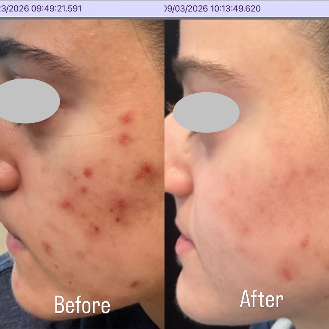 Instagram post by Dr. Sylvie Khorenian: Combination of a simple topical therapy, spironolactone, and a series of #lasergenesis for the severe scarring from picking helped clear thi…