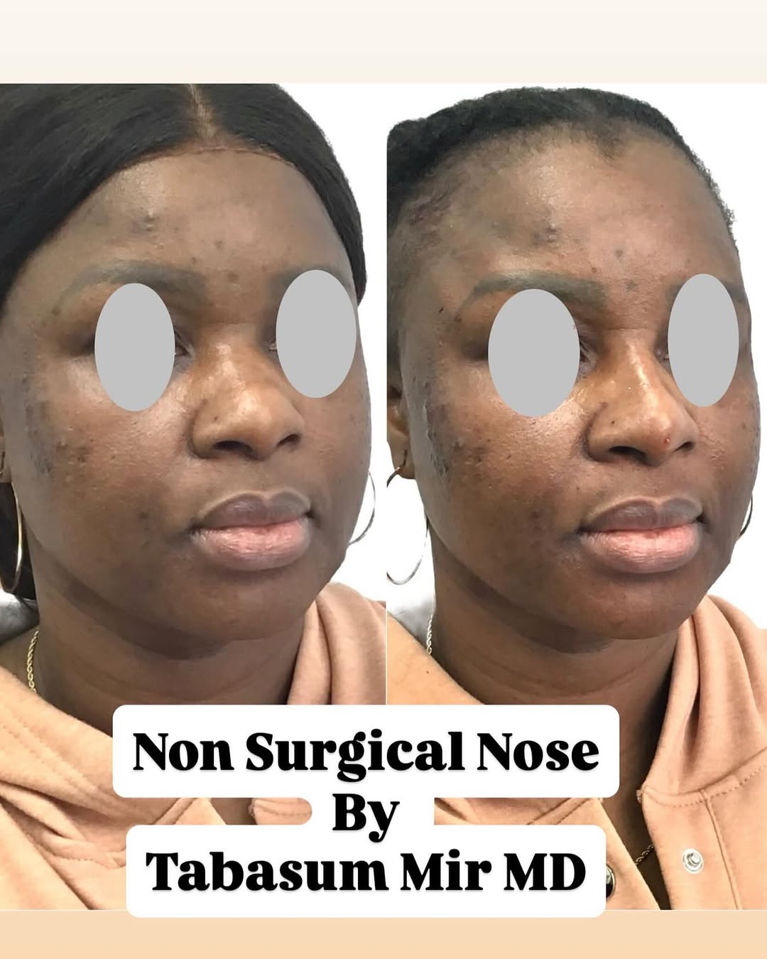 Instagram post by Dr. Tabasum Mir: 👃✨ A beautiful nose without surgery or filler. This non-surgical nose reshaping is performed using PDO threads—not injectable fillers. Thre…