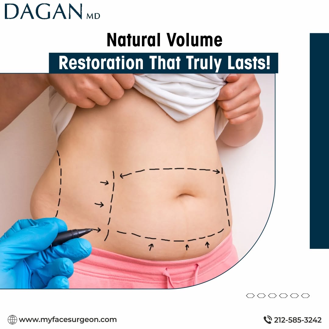 Instagram post by Dr. Tal Dagan: Say goodbye to hollow cheeks and fine lines. Dr. Dagan’s fat transfer technique restores facial fullness using your own fat—safe, biocompati…