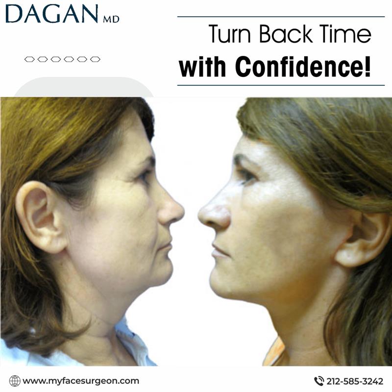 Instagram post by Dr. Tal Dagan: Reclaim your youthful appearance with a facelift by Dr. Tal Dagan. This transformative procedure removes sagging skin, smooths deep lines, a…