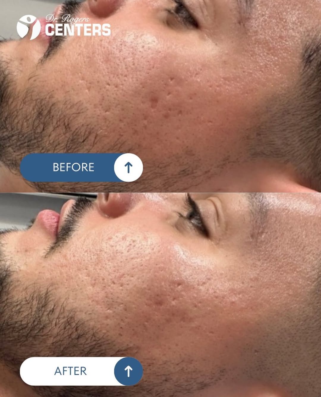 Instagram post by Dr. Tamyra L. Rogers: See what’s possible with the right treatment plan.💙 This before & after highlights the results of a patient who received our RF Microneedli…