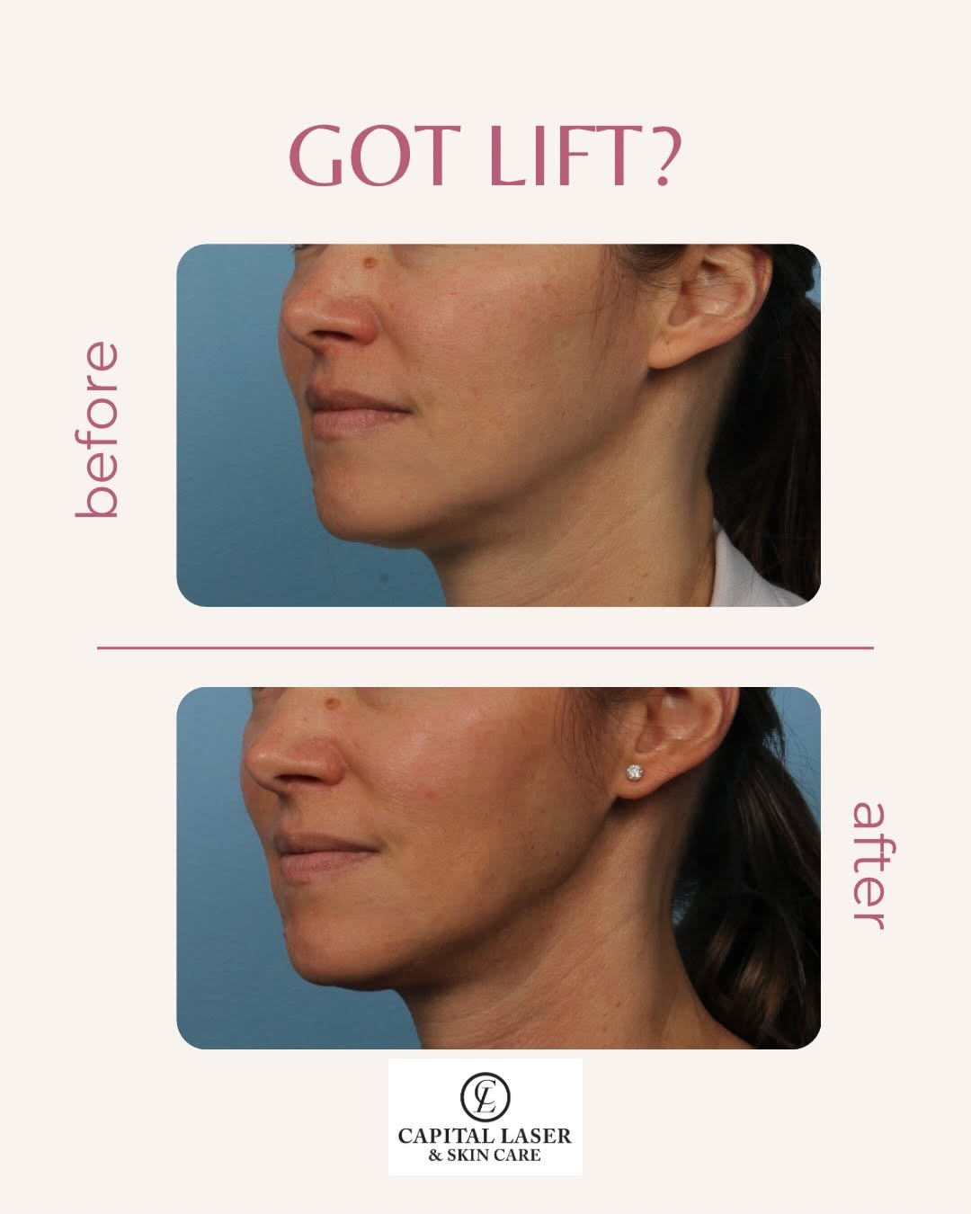 Instagram post by Dr. Tania Peters: Loving my Sofwave! #gotlift #gotliftday2026 #sofwave