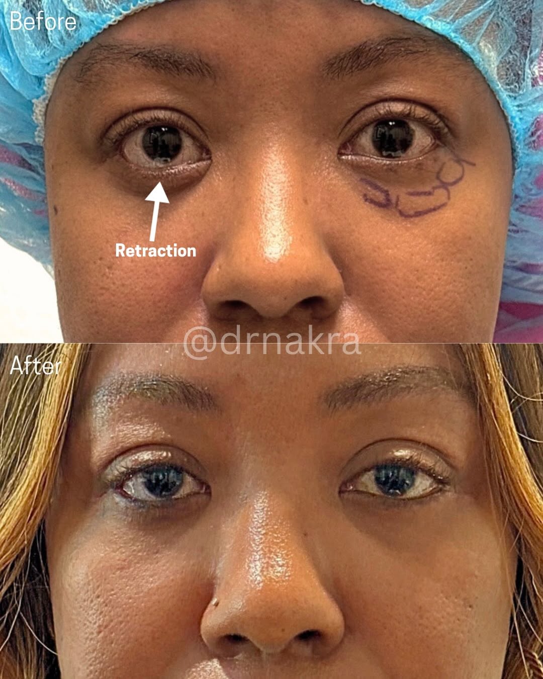 Instagram post by Dr. Tanuj Nakra: Reconstructive surgery and cosmetic surgery overlap…? This lovely 43-year-old came to us after a long difficult journey after an orbital fra…