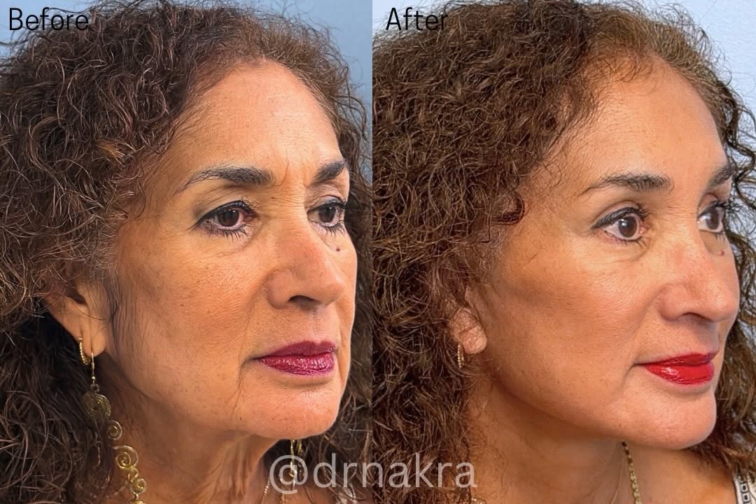 Instagram post by Dr. Tanuj Nakra: This vibrant 71 year old did NOT feel her age, and disliked her heavy neck and droopy eyelids. Here’s the plan we decided on together: ⭐️ Pr…