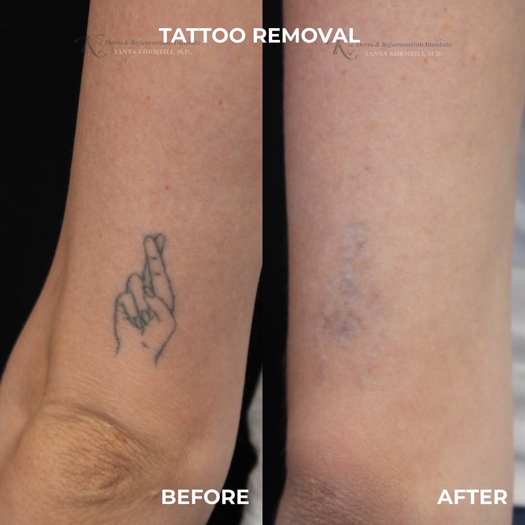 Instagram post by Dr. Tanya Kormeili: Tattoo removal laser treatment 🩶 We’re a dermatology clinic located in Santa Monica, CA. We specialize in skin checks, lasers, fillers, neu…