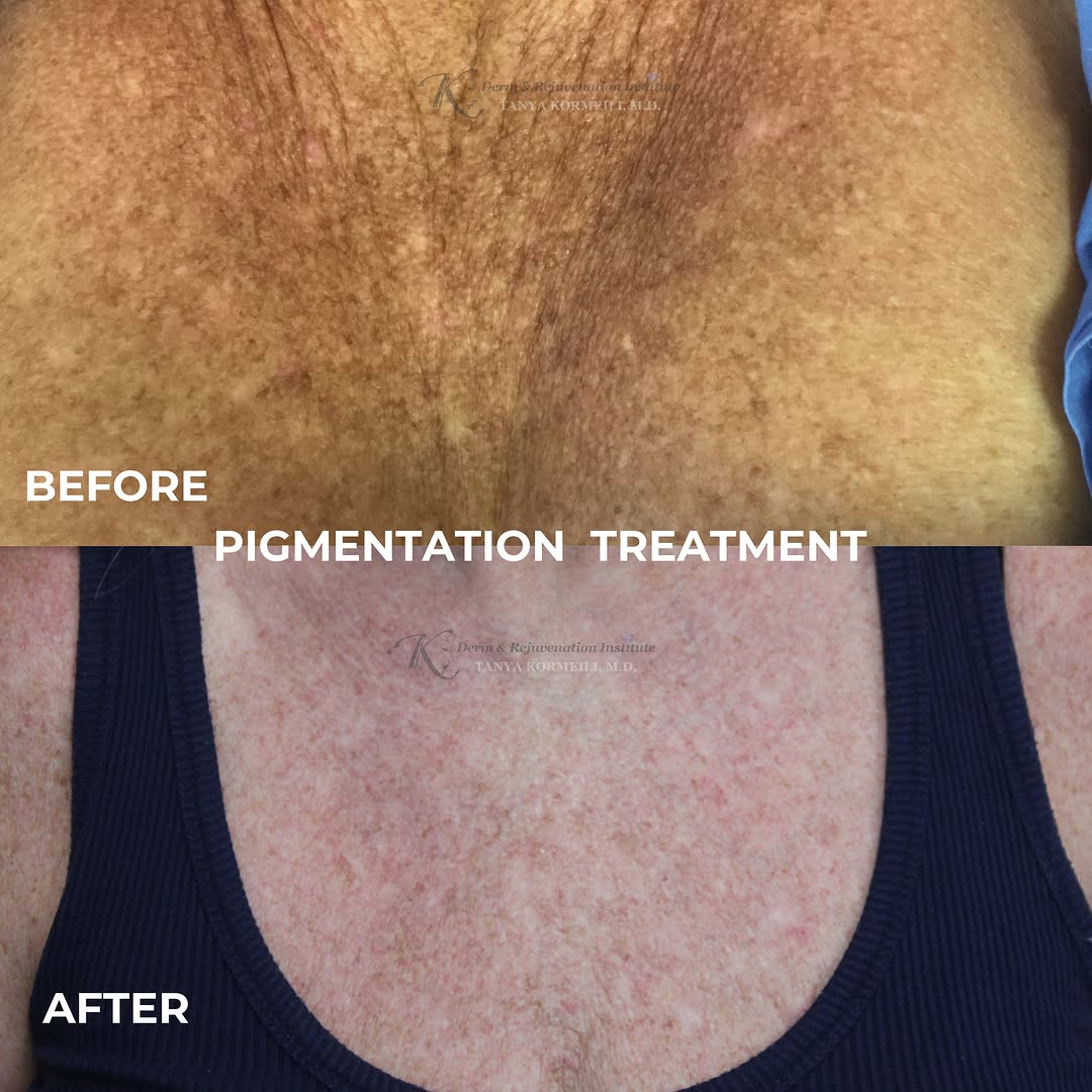 Instagram post by Dr. Tanya Kormeili: Sun damage pigmentation treatment 🩶 Request your appointment in bio 🔗 Derm & Rejuvenation Institute Santa Monica, CA 310-526-8301 staff@dr…