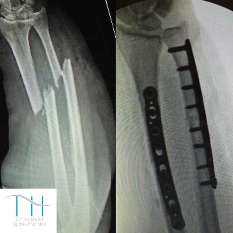 Instagram post by Dr. Tarik Husain: This patient sustained an open fracture of the forearm called a both bone fracture and more specifically radial and ulnar shaft fractures. S…