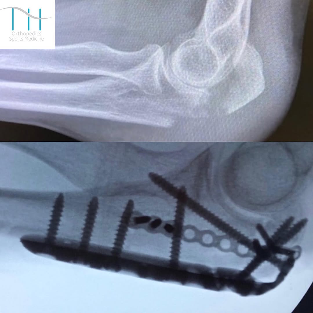 Instagram post by Dr. Tarik Husain: Olecranon fracture is a fracture of the bony portion of the elbow. The injury is fairly common and often occurs following a fall or direct t…