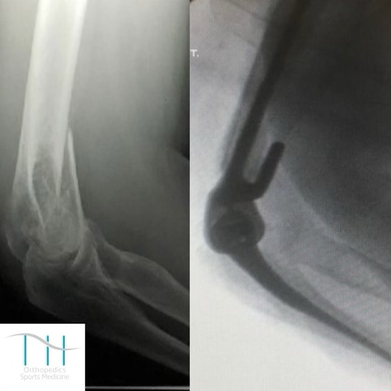 Instagram post by Dr. Tarik Husain: Good Day To All ☀️ This patient was an elderly woman who fell and fractured her elbow. She had what is called a distal humerus fracture in m…