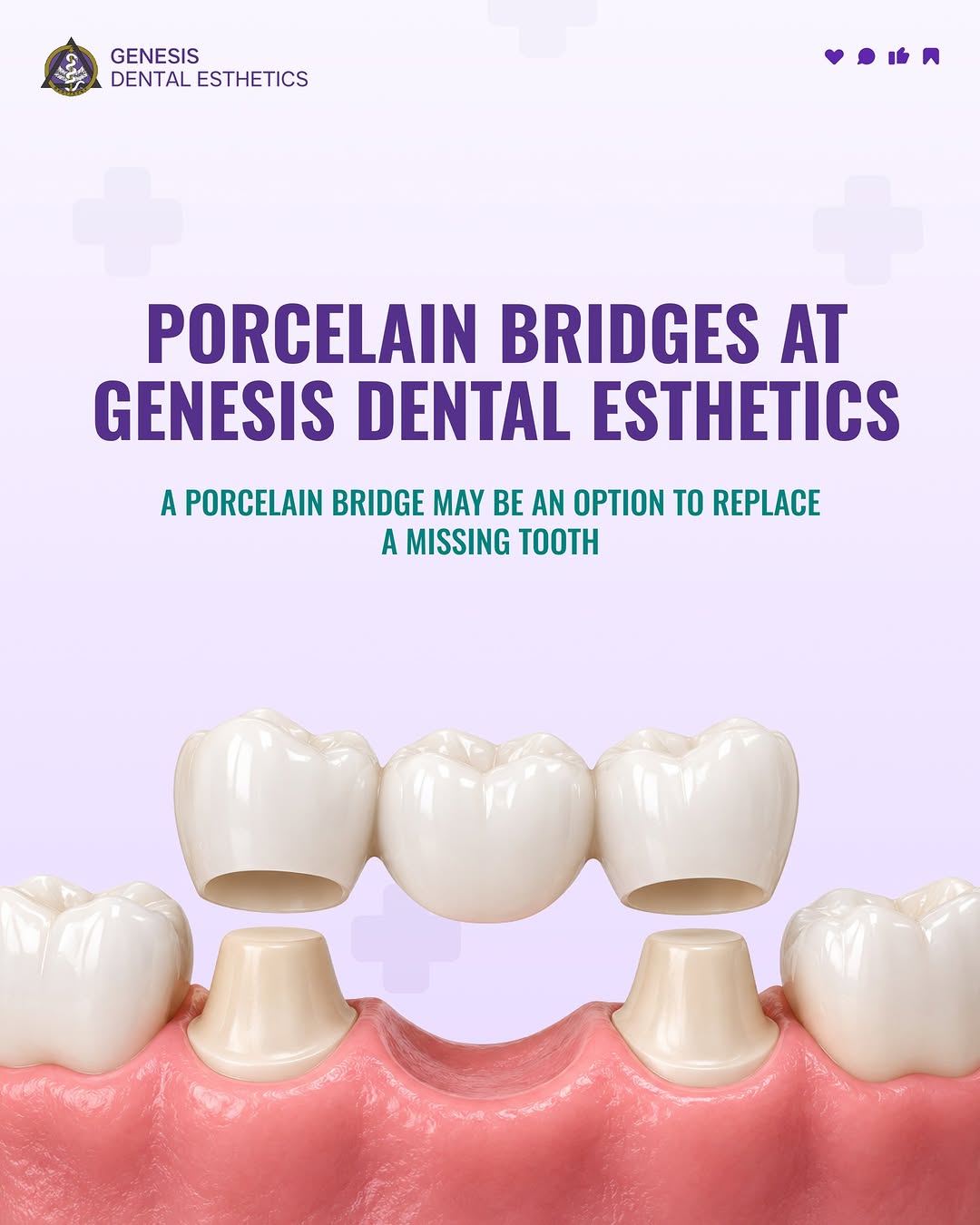 Instagram post by Dr. Ted Baghdasarian: A porcelain bridge may help restore more than your smile. 🦷 At Genesis Dental Esthetics, porcelain bridges can be used to replace a missing…