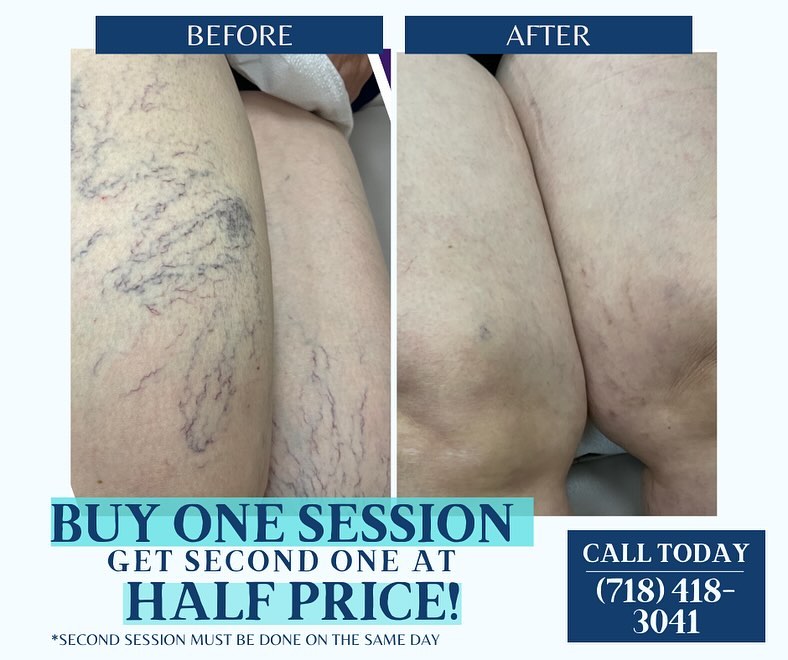Instagram post by Dr. Ted Brezel: ‼️PROMO‼️ Wanting to get rid of unwanted leg veins? At Glendale dermatology get Sclerotherapy with buy one get one half off sessions! Call 7…
