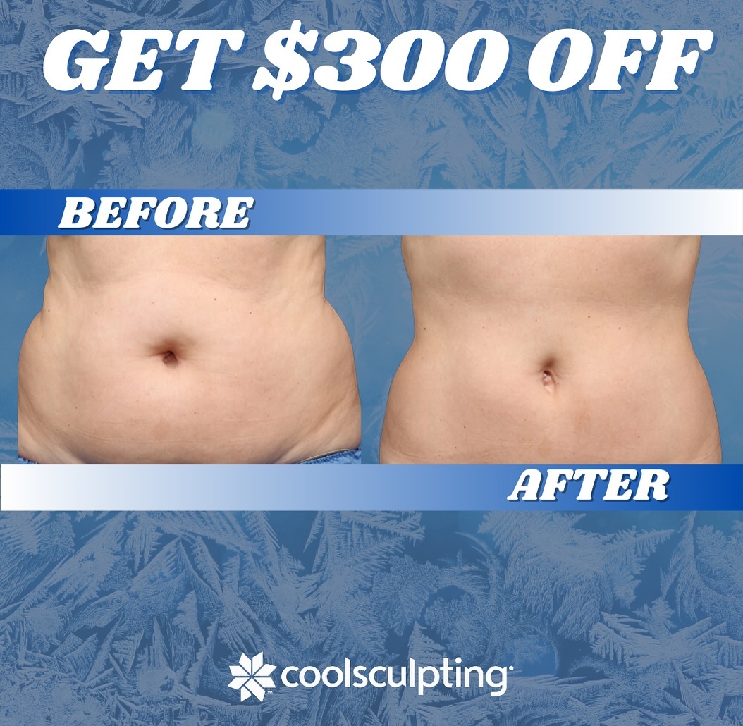 Instagram post by Dr. Ted Brezel: CoolMonth is upon us! Take advantage of this AMAZING DEAL you won’t wanna miss! ⤵️ 🚨Get $300 off CoolSculpting® TODAY!🚨 Does It Work? Typi…