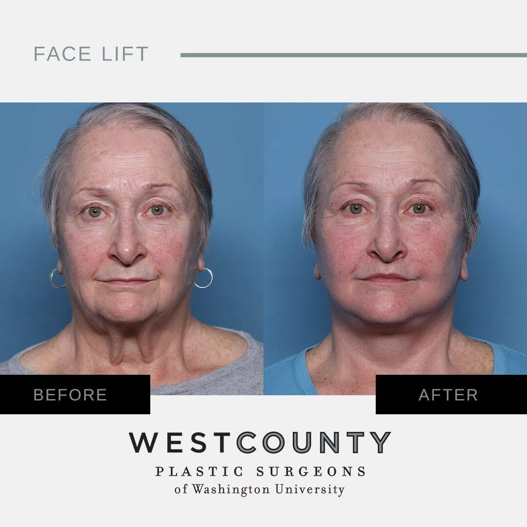 Instagram post by Dr. Terence Michael Myckatyn: This beautiful 69-year-old woman was bothered by the effects of aging on her lower face and neck, and disliked her jowls. She underwent a lo…