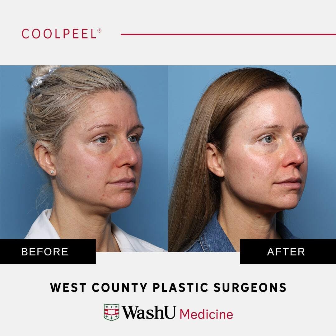 Instagram post by Dr. Terence Michael Myckatyn: This beautiful 35-year-old woman underwent three CoolPeel™ treatments with our Physician Assistant to achieve rejuvenated, resurfaced skin. …