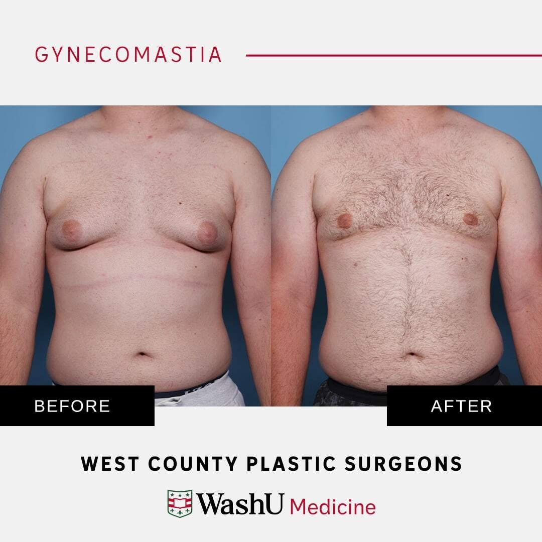 Instagram post by Dr. Terence Michael Myckatyn: This 19-year-old man was bothered by excess breast tissue. He underwent gynecomastia correction along with suction-assisted lipectomy to ach…