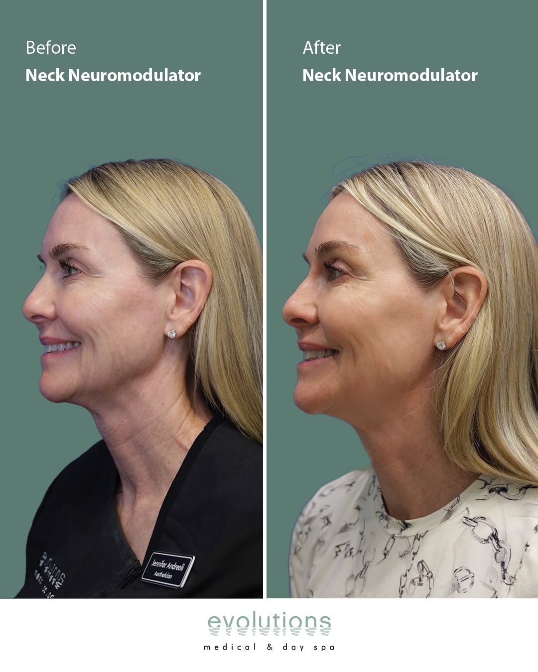 Instagram post by Dr. Terry J. Perkins: Before + After Botox treatment for Platysma Bands 💉 Platysma bands are the strips of muscle connecting your jaw and neck that can cause sag…