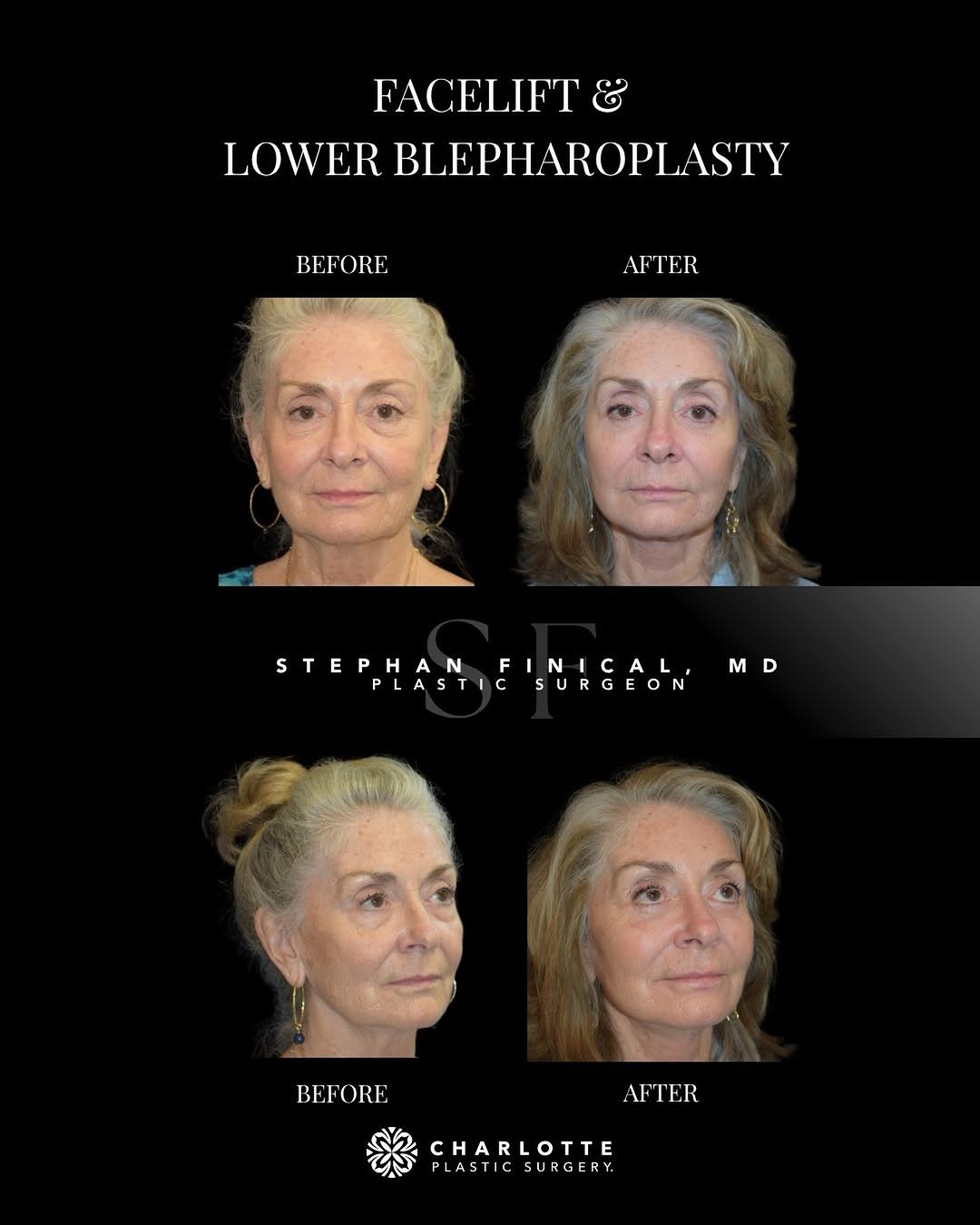 Instagram post by Dr. Theodore Nyame: This before-and-after showcases the results of a facelift and lower blepharoplasty, addressing two areas that can significantly impact the o…