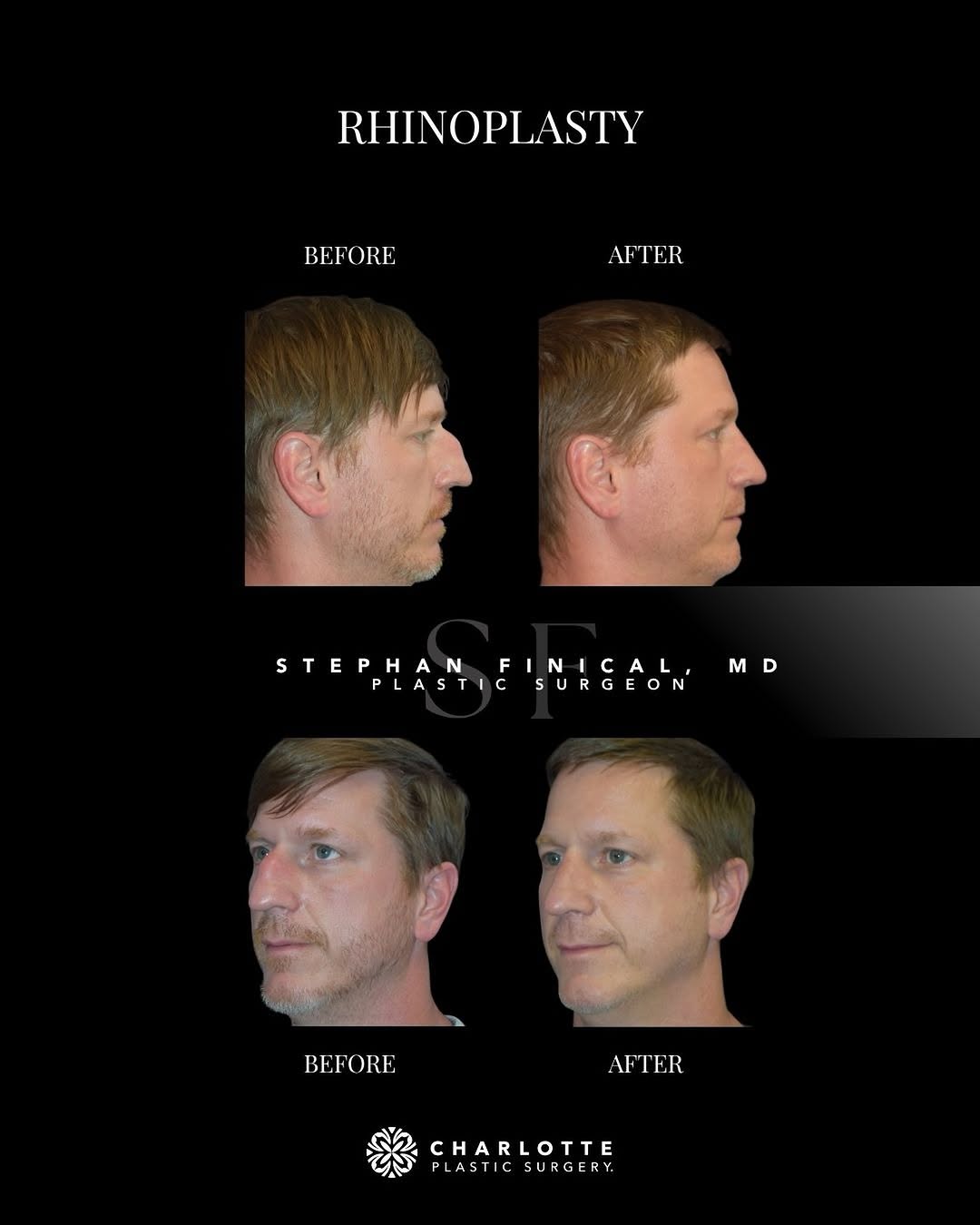 Instagram post by Dr. Theodore Nyame: Male rhinoplasty can refine the nose while maintaining a natural, masculine appearance that complements the rest of the face. In this rhinop…