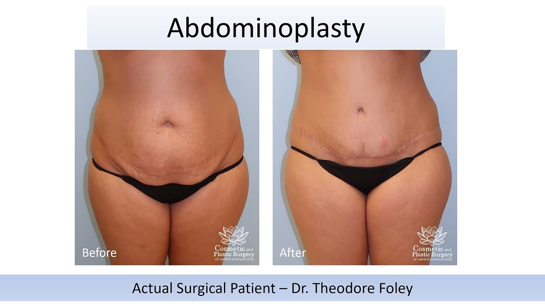 Instagram post by Dr. Theodore T. Foley: Before and after photos for an actual patient with our plastic surgeon, Theodore Foley, MD. This patient was seeking to reduce her abdominal…