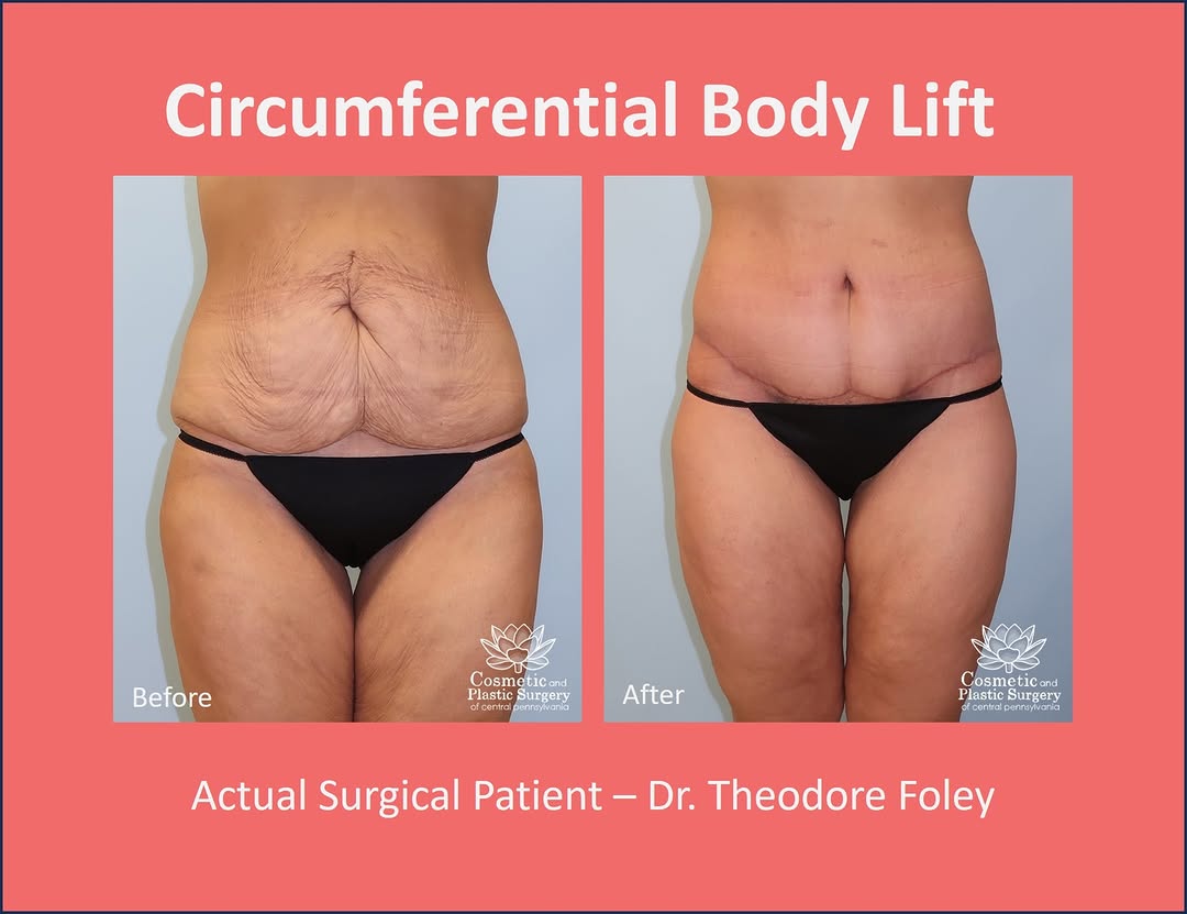 Instagram post by Dr. Theodore T. Foley: This patient was bothered by her abdomen, flanks and thighs with skin laxity. She experienced significant weight loss over the last several …
