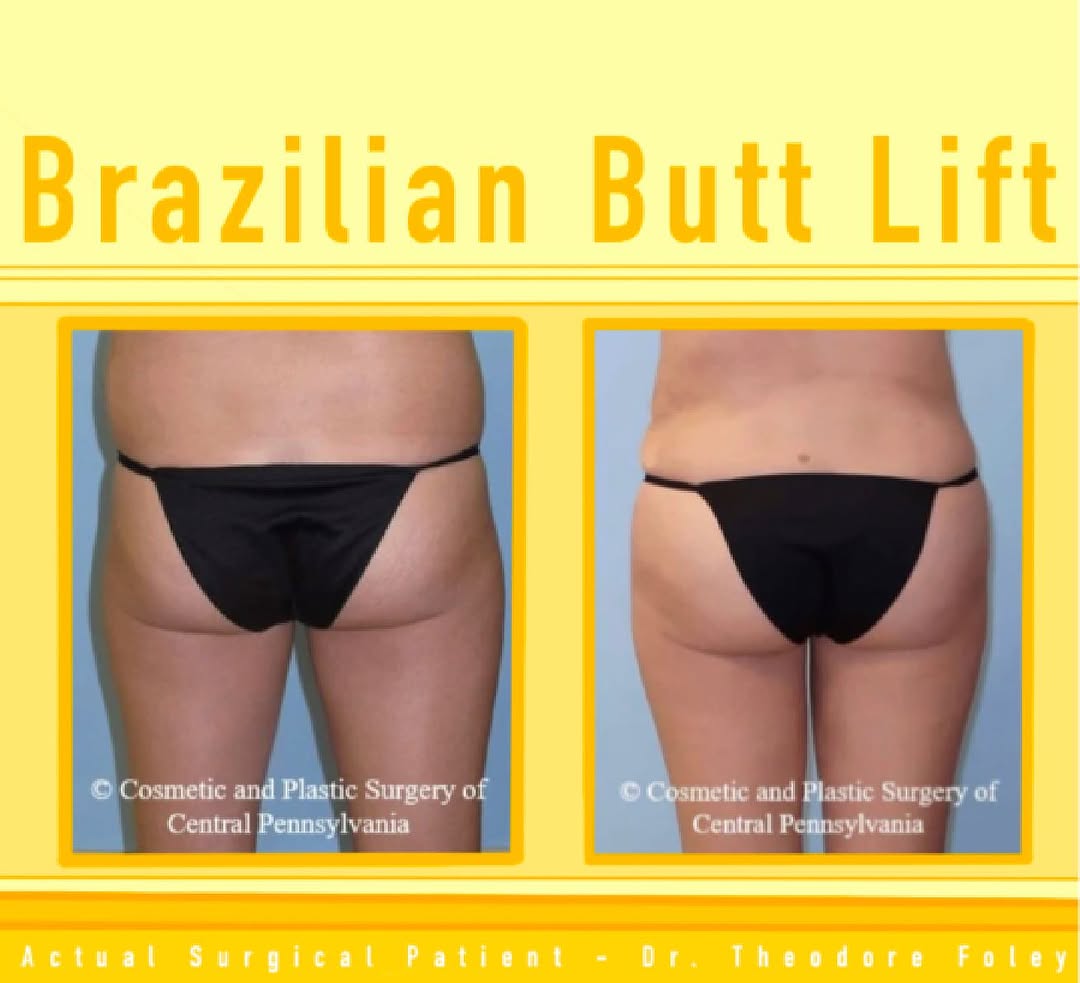 Instagram post by Dr. Theodore T. Foley: • BBL (Brazilian Butt Lift) procedure performed by Dr. Foley • A Brazilian Butt Lift enhances the contour of the buttocks. It provides stunn…
