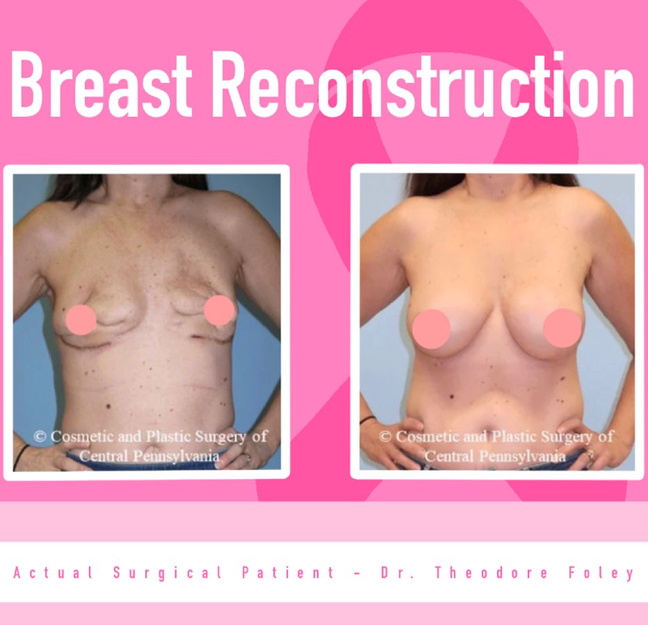 Instagram post by Dr. Theodore T. Foley: • October 1st marked the beginning of Breast Cancer Awareness Month! 🎀🌸🎗️ • Today we are highlighting a breast reconstruction patient. Br…