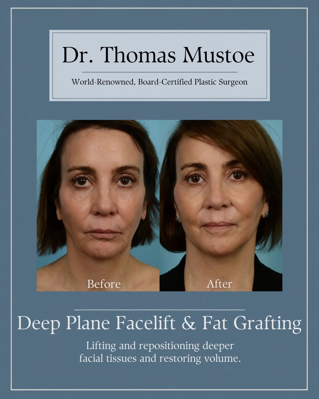 Instagram post by Dr. Thomas A. Mustoe: This patient's procedure combined a Deep Plane Facelift with fat grafting to address volume loss and laxity in the lower face and neck. The …