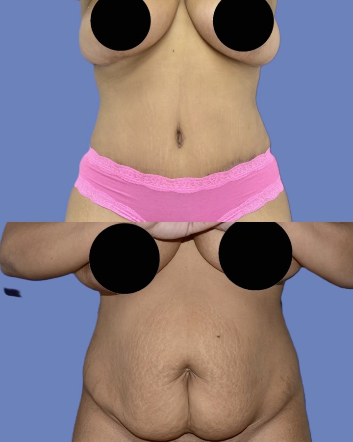 Instagram post by Dr. Thomas A. Pane: A tummy tuck is about more than just removing extra skin. 👏🏼 During an abdominoplasty, we can remove loose or excess skin, address stubbor…