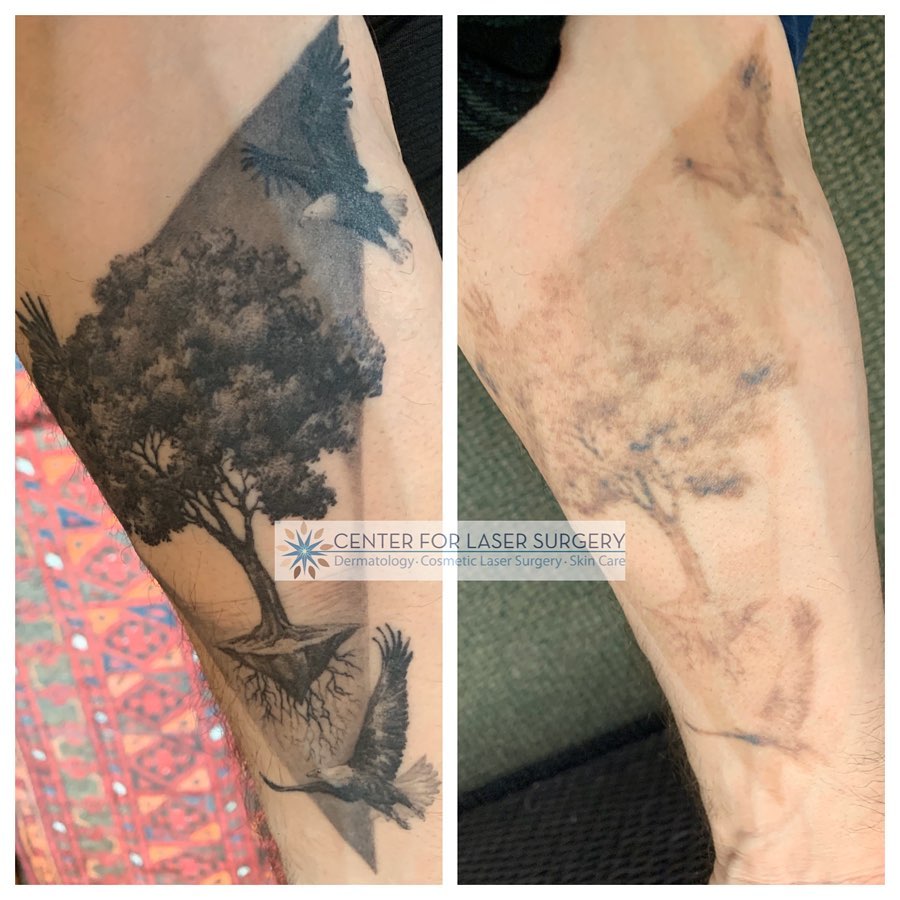 Instagram post by Dr. Thomas Adrian: Just 4 treatments with the @wontech_laser #PicoCare laser and this tattoo is nearly toast. The PicoCare is the most powerful picosecond Nd:y…